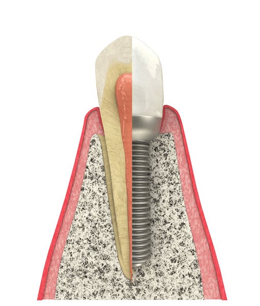 Benefits of Dental Implants in Bourbonnais, IL